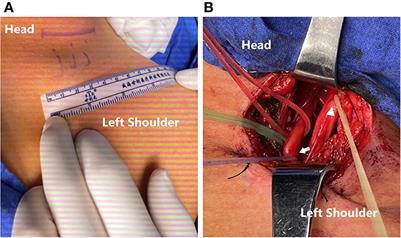 Posterior division of ipsilateral C7 transfer to C5 for shoulder abduction limitation